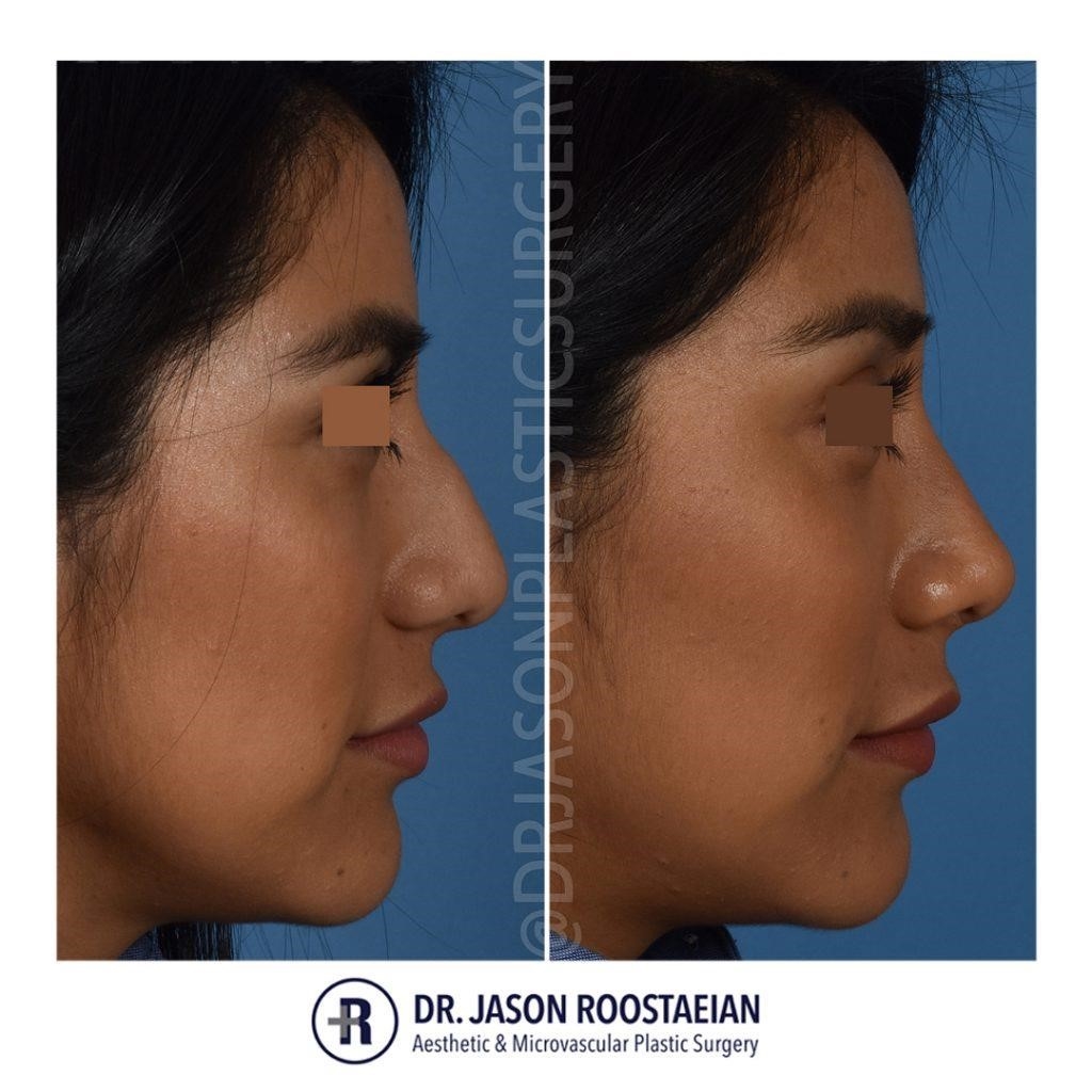 revision rhinoplasty experts